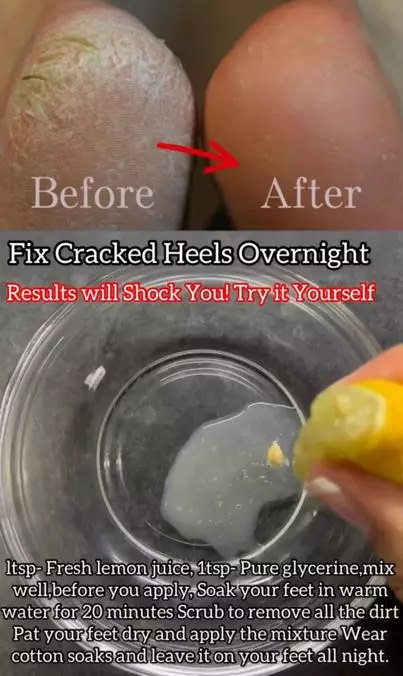 Haluskan tumit retak pakai 1 jenis buah-buahan Berbagai sumber