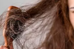 Cara mengatasi rambut botak area dahi pakai 2 jenis minyak, tak perlu lagi serum penumbuh