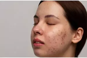 Tak butuh acne gel, ini cara menghilangkan bekas jerawat membandel cuma dengan 1 jenis umbi-umbian
