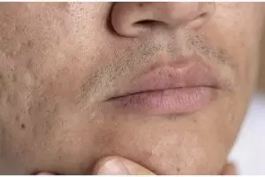 Cara mudah membersihkan pori-pori wajah agar tak gampang berjerawat, hanya pakai 1 bumbu dapur