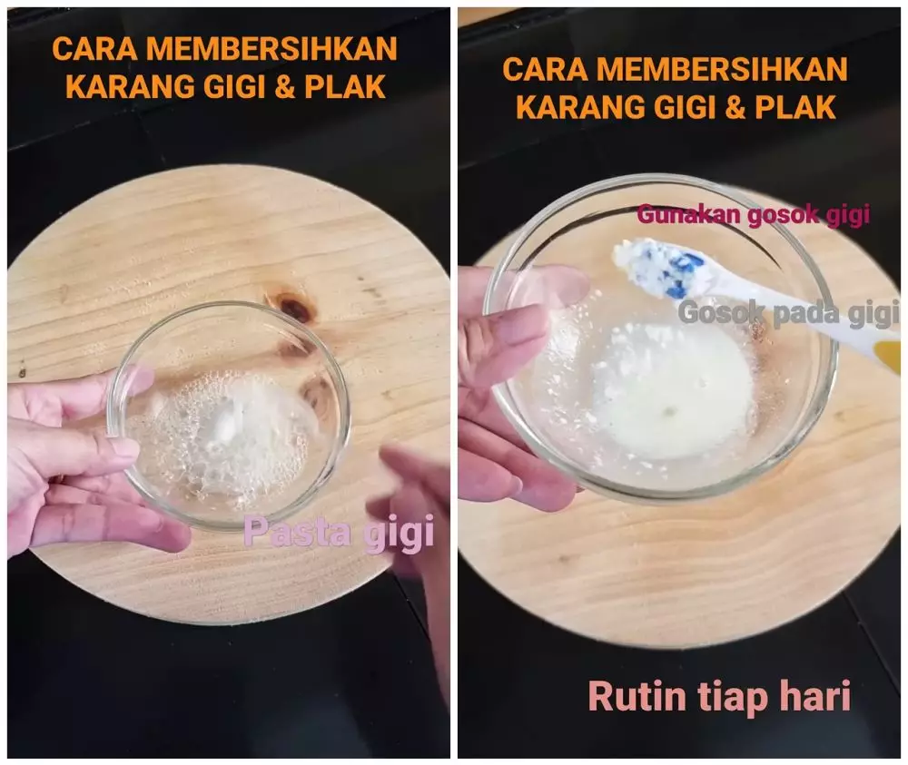 cara mudah bersihkan karang gigi © YouTube