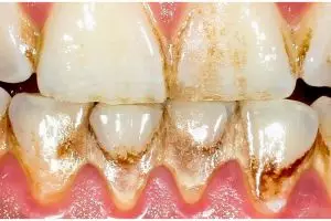 Tak perlu garam, ini cara mudah bersihkan karang gigi dan hilangkan plak yang bikin gigi kuning