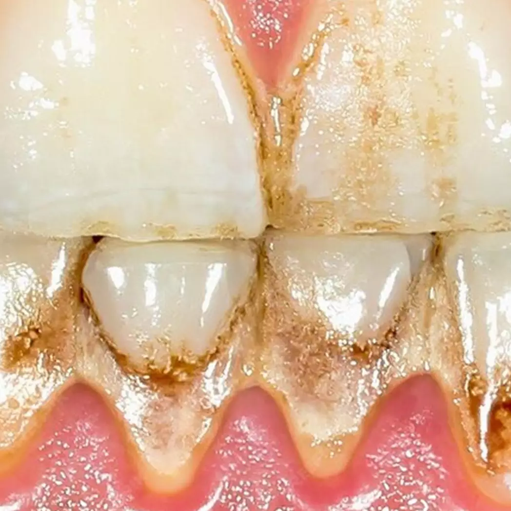 Tak perlu garam, ini cara mudah bersihkan karang gigi dan hilangkan plak yang bikin gigi kuning