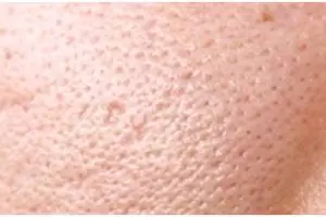 Wajah mulus dan bening tanpa skincare, ini cara alami mengecilkan pori-pori pakai 1 bahan pemanis