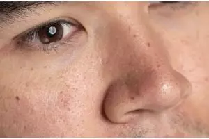 Bukan pakai putih telur atau gula, cara menghilangkan komedo membandel ini bikin wajah lebih mulus