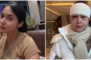 9 Potret Dilan jalani operasi plastik usai diselingkuhi suami, warganet ungkap kekecewaan