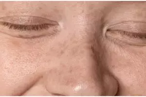 Kulit glowing tanpa retinol, ini cara hilangkan kerutan dan flek hitam di wajah pakai 1 jenis protein