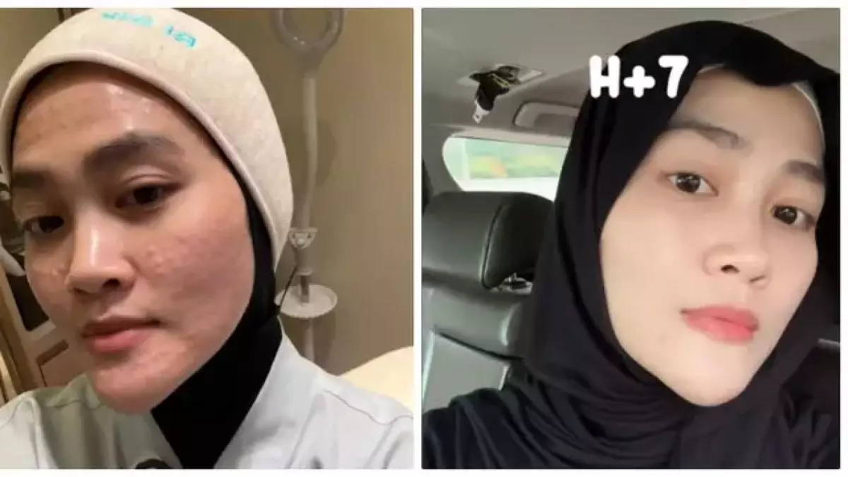 6 Potret tranformasi wajah Henny Rahman istri Alvin Faiz usai perawatan, berubah glowing dan mulus