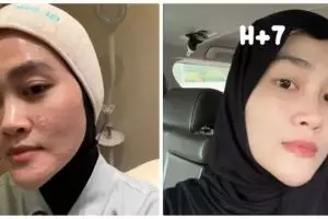 6 Potret tranformasi wajah Henny Rahman istri Alvin Faiz usai perawatan, berubah glowing dan mulus