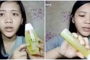 Tak perlu laser ratusan ribu, cara hilangkan milia di wajah ini ekonomis cuma pakai produk Rp7 ribuan