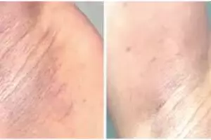 Cara ampuh mencerahkan ketiak gelap dan penuh lipatan agar mulus lagi pakai 1 bahan dapur ini