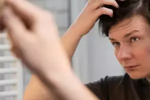 Trik mengatasi rambut botak area dahi pakai 2 jenis minyak, nggak perlu serum penumbuh