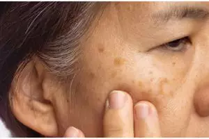 Trik menghilangkan flek dan bintik hitam hanya pakai 1 jenis buah, wajah cerah bebas noda