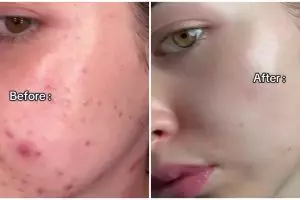 Bekas jerawat meradang? Begini cara menghilangkannya cuma dengan masker dari 3 bahan dapur