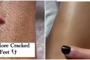 Tak cukup diberi lotion, ini trik melembapkan kulit kering dan pecah-pecah pakai 1 jenis tanaman
