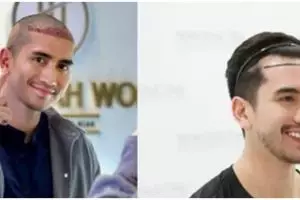 13 Potret seleb sebelum dan sesudah transplantasi rambut ini penampilannya jadi tampak lebih muda