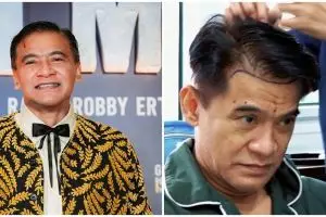 Nggak pede hairline mundur, begini 7 potret Donny Damara jalani transplantasi rambut