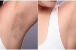 Auto cerah dan mulus dalam 1 minggu, cara atasi ketiak gelap ini ampuh pakai 1 bumbu dapur