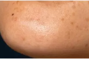 Bukan dengan exfoliasi, ini cara atasi tekstur kulit ayam di wajah agar mulus pakai 1 bahan pemanis