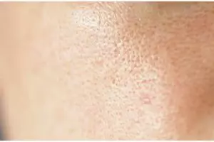 Tak perlu air beras, begini cara mengatasi pori-pori besar cuma dengan toner dari 1 bahan minuman