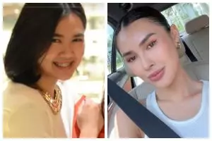Habiskan Rp300 juta, begini 5 potret wajah Michelle Halim sebelum dan sesudah operasi hidung