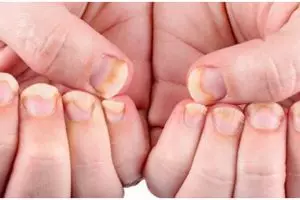 Jamur di kuku hilang dalam seminggu, ini cara mengatasinya secara alami cuma dengan 1 bumbu dapur