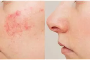 Tanpa acne gel, ini cara cepat meredakan jerawat meradang cuma dikompres pakai 1 ampas buah ini