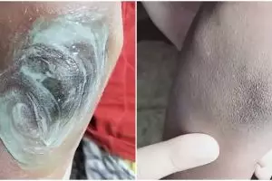 Cara cepat memutihkan siku dan lutut menghitam ini ampuh cuma dengan 1 bahan minuman