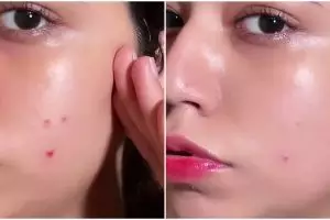 Cara cepat memudarkan bekas jerawat dalam sekejap cuma dengan 2 bahan dapur