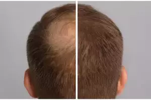 Cara bikin hair tonic untuk tumbuhkan rambut agar lebih lebat, lembut, dan tak mudah rontok