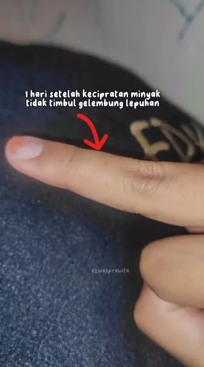 trik tangan tak melepuh usai terkena minyak © TikTok