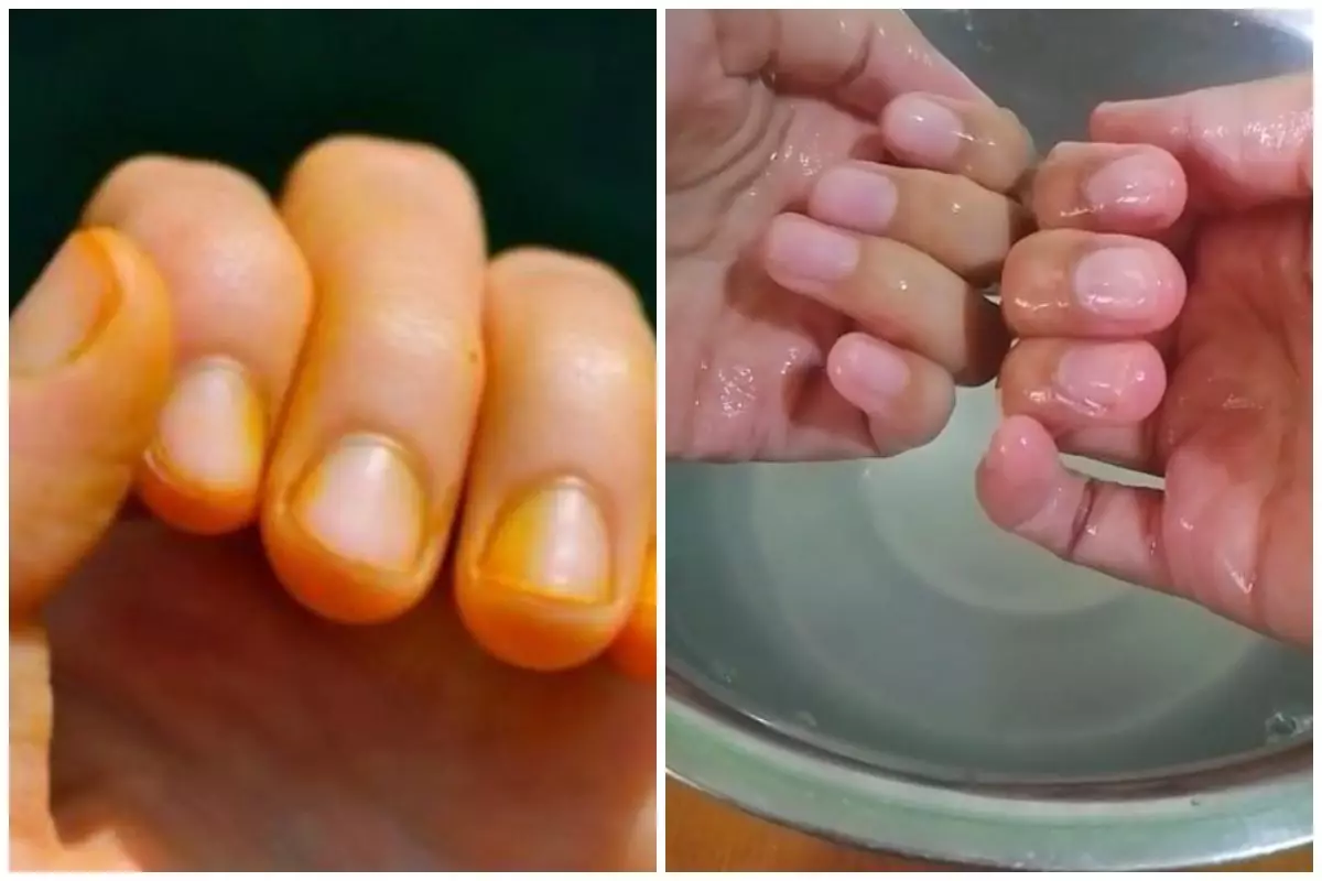 Bukan digosok alkohol, ini trik cepat hilangkan noda kunyit di kuku dan tangan pakai 1 bahan sederhana