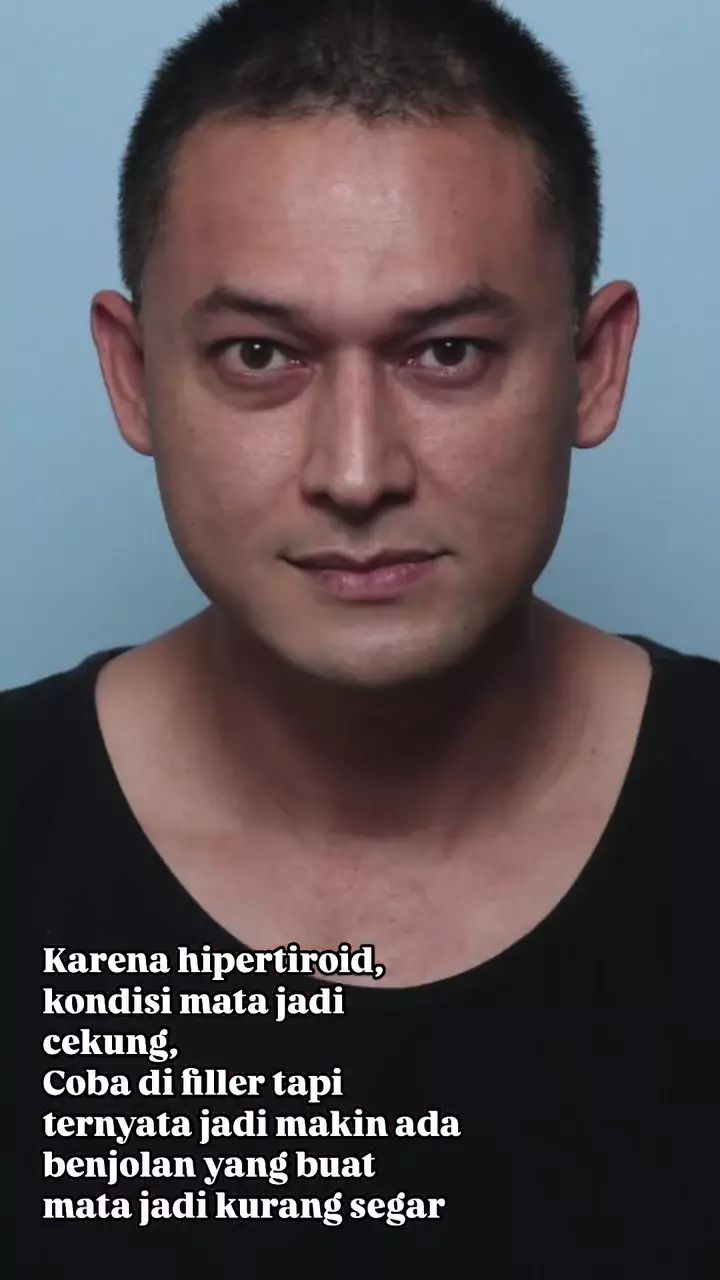 indra bruggman usai oplas mata © 2025 Instagram indra bruggman usai oplas mata © 2025 Instagram