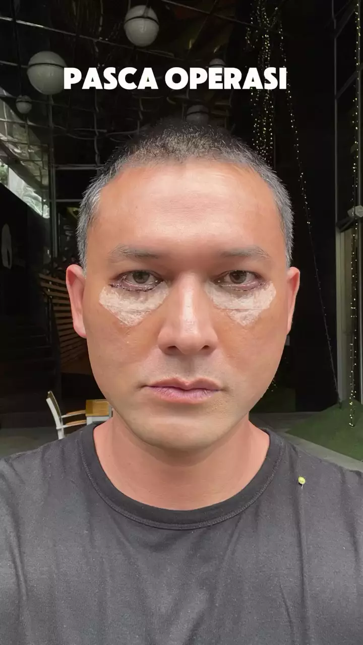 indra bruggman usai oplas mata © 2025 Instagram indra bruggman usai oplas mata © 2025 Instagram