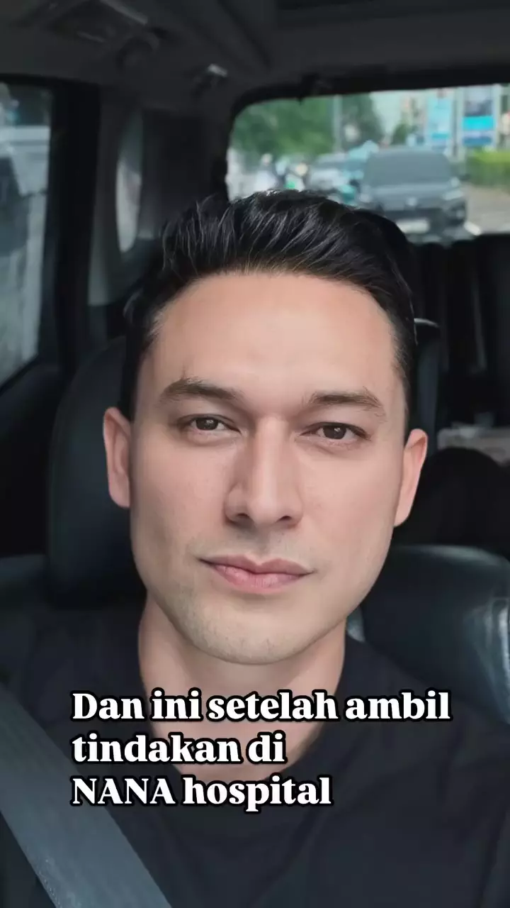 indra bruggman usai oplas mata © 2025 Instagram indra bruggman usai oplas mata © 2025 Instagram