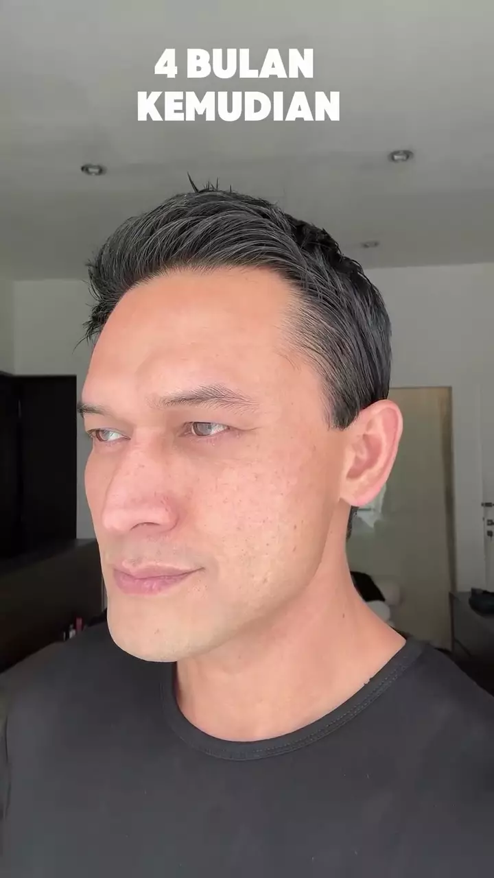 indra bruggman usai oplas mata © 2025 Instagram indra bruggman usai oplas mata © 2025 Instagram