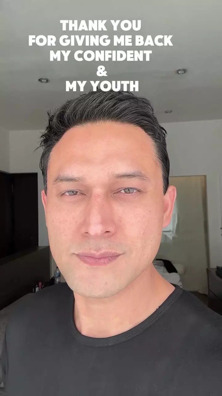 indra bruggman usai oplas mata © 2025 Instagram indra bruggman usai oplas mata © 2025 Instagram