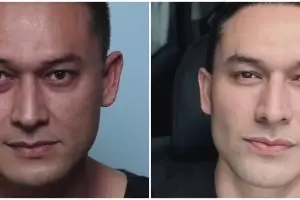 Mata cekung karena hipertiroid, 9 potret Indra Bruggman usai oplas ini dipuji makin tampan