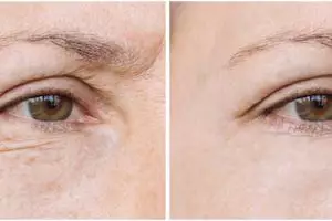 Jadi kencang lagi, ini cara samarkan garis halus dan kerutan di bawah mata pakai serum alami