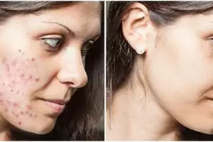 Cara mudah hilangkan bekas jerawat dan bintik hitam di wajah pakai 1 jenis buah