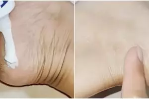 Tak perlu pakai obat atau salep, ini cara hilangkan kapalan di kaki agar kulit mulus tak pecah-pecah