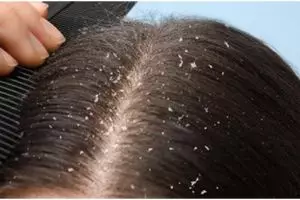 Cara membasmi ketombe ini bikin kulit kepala bersih, dijamin antigatal dan nggak balik lagi