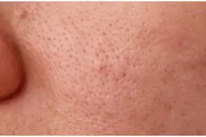 Cukup andalkan 1 jenis bunga, begini cara alami kecilkan pori-pori wajah tanpa merusak kulit