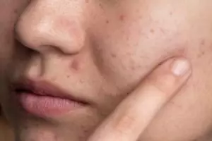 Cara menghilangkan beruntusan pakai masker dari 1 bahan pemanis, wajah mulus bebas gradakan