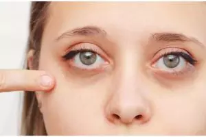 Cara atasi dark circle dan kantung mata pakai 1 jenis bahan pemanis, nggak perlu minyak zaitun