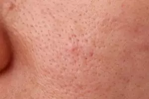 Cara membersihkan pori-pori tersumbat pakai 1 jenis minuman, wajah auto glowing dalam sekejap