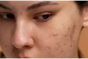 Sampai dikira habis oplas, begini cara hilangkan flek hitam cuma pakai 1 jenis lalapan