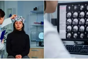 Perlu diwaspadai, ini 8 penyebab pendarahan otak yang sering tak disadari