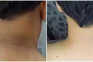 Cara mudah atasi punggung leher menghitam dan penuh lipatan ini auto mulus pakai 1 jenis minuman