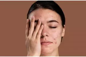 Ternyata ini cara hilangkan beruntusan dan jerawat tanpa perih, kulit mulus cuma pakai 1 ampas dapur